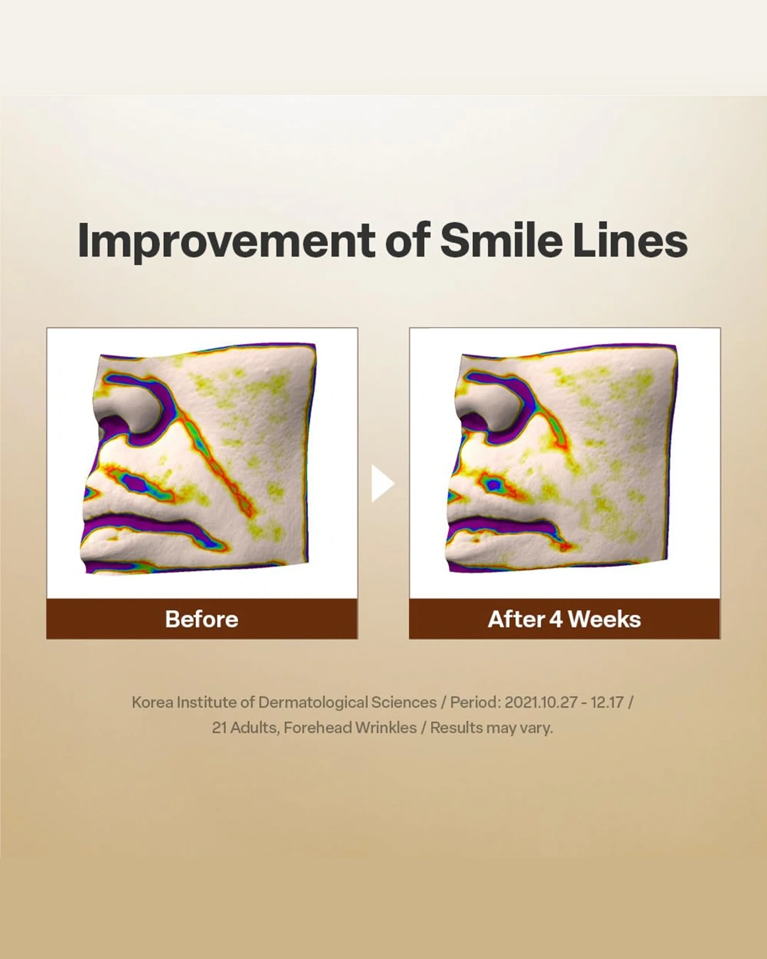 A promotional infographic showing before-and-after results for smile lines and forehead wrinkles. The left panel is labeled 'Before' and the right panel 'After 4 Weeks,' with a white arrow between them.