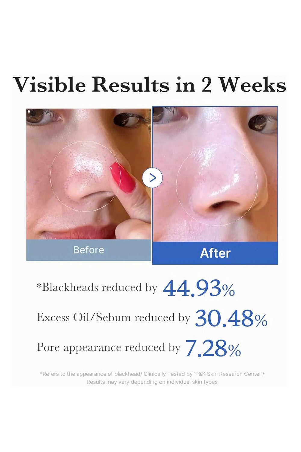 Before and after comparison of a nose with visible blackheads, labeled 'Before' and 'After', showing reduced blackheads, excess oil/sebum, and pore appearance.