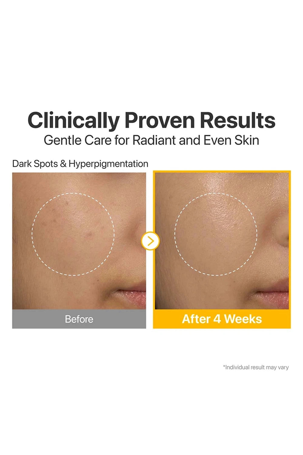 Before and after comparison of skin treatment for dark spots and hyperpigmentation with text 'Clinically Proven Results'.