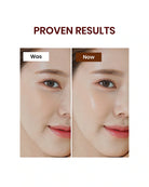 Before-and-after skin comparison graphic with the text 'PROVEN RESULTS' above two close-up facial photos labeled 'Was' and 'Now' on a white background.