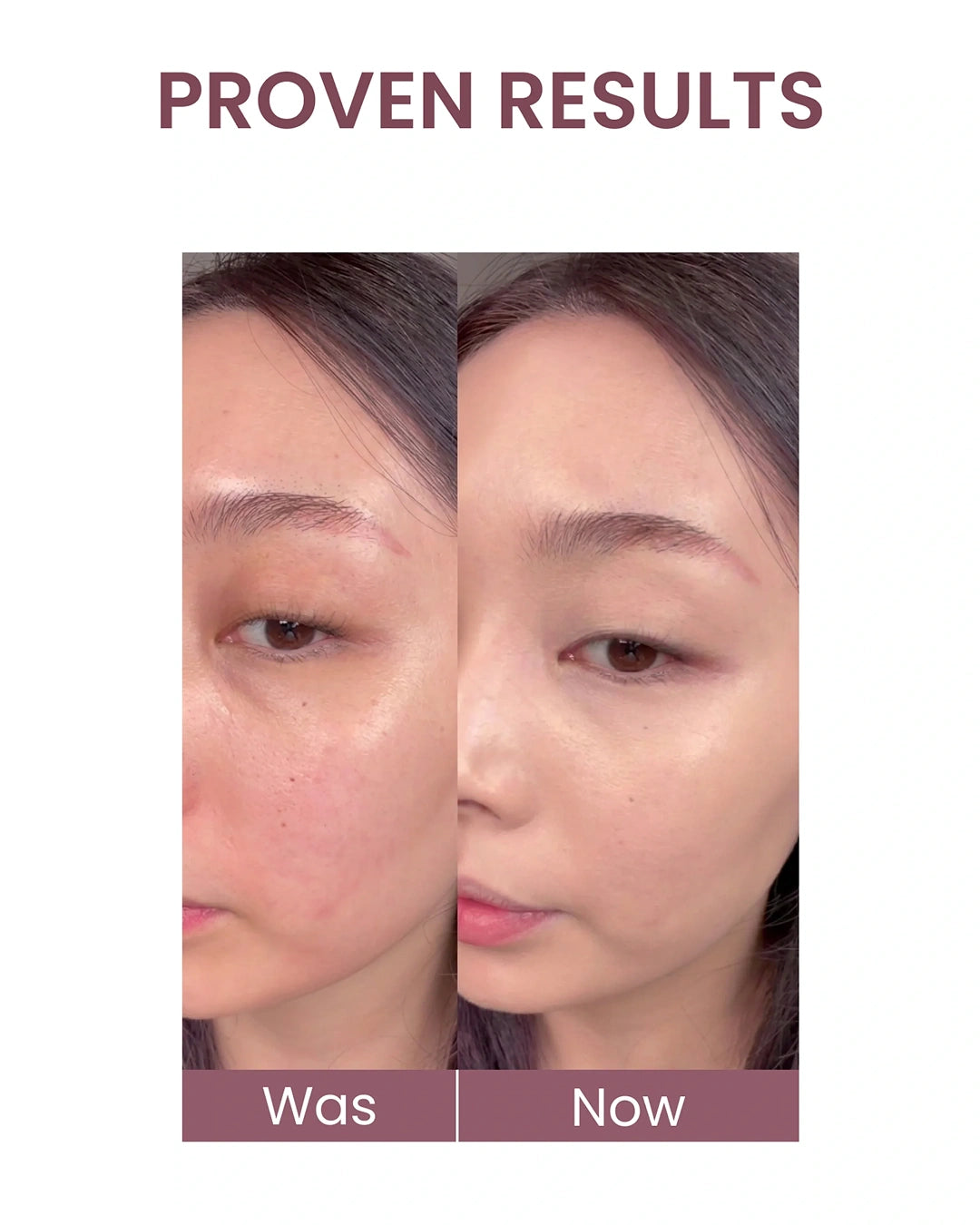 Before-and-after comparison of a woman's face showing skin improvement, with the text 'PROVEN RESULTS' at the top and 'Was' and 'Now' labels at the bottom.