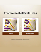 A promotional infographic showing before-and-after results for smile lines and forehead wrinkles. The left panel is labeled 'Before' and the right panel 'After 4 Weeks,' with a white arrow between them.