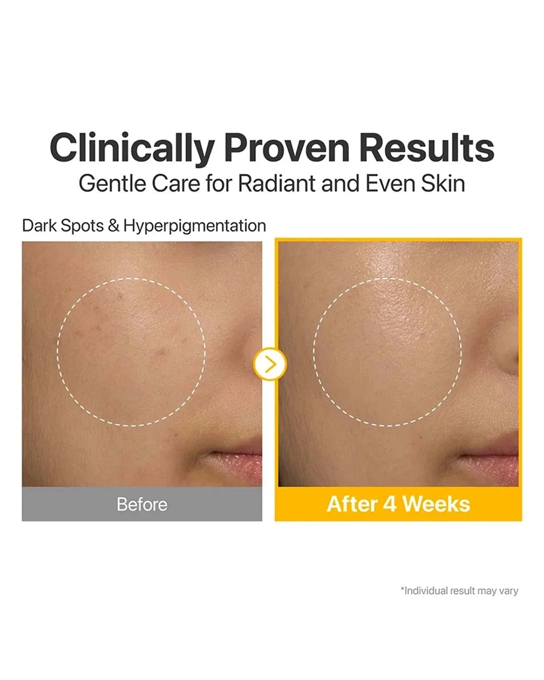 Before-and-after skin comparison graphic showing a close-up of a cheek with dark spots and hyperpigmentation, labeled 'Before' on the left and 'After 4 Weeks' on the right, with the headline 'Clinically Proven Results' above.