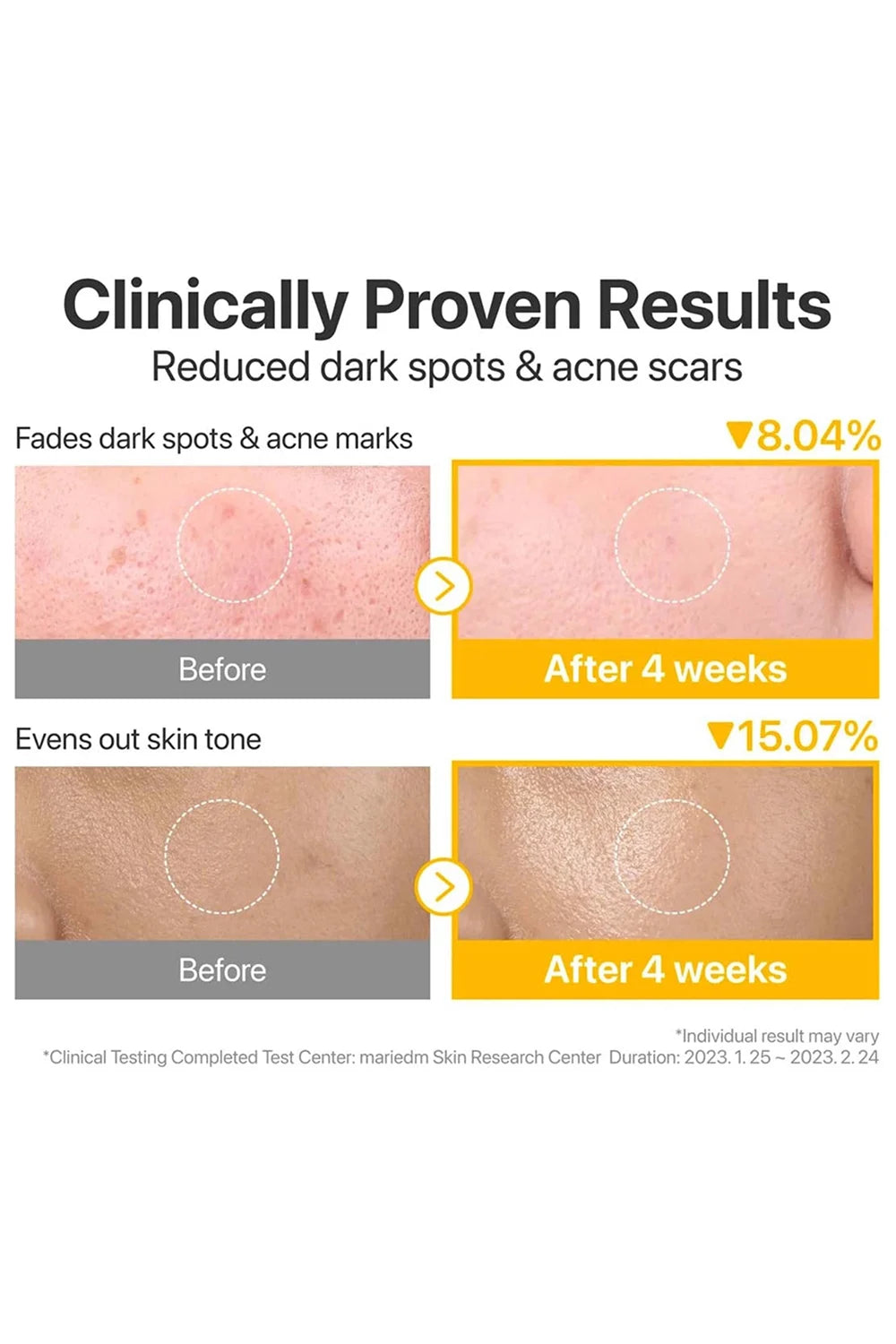 Before and after skin treatment results showing reduced dark spots and acne scars with clinical proven effectiveness.