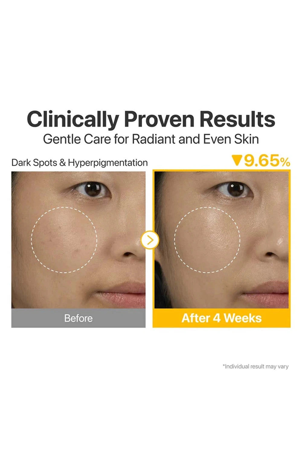 Before and after comparison of dark spots and hyperpigmentation treatment with text 'Clinically Proven Results' on a white background.